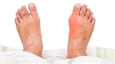 كل ما تريد معرفتة عن مرض النقرس من اعراض وعلاجة وطرق الوقاية منة