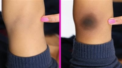 تفتيح الكوعين والركبتين بـ 4 وصفات طبيعية في المنزل