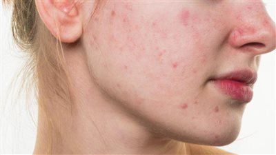 وصفات طبيعية للبشرة لعلاج حب الشباب