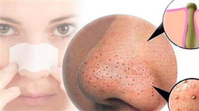 علاج لازاله الرؤوس السوداء