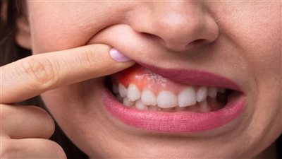 تحذير من التهاب اللثة تصيبك باربع امراض خطيرة