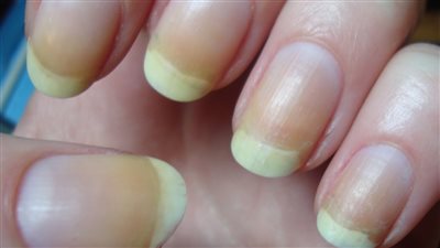 اظافرك تدق ناقوس الخطر وتكشف عن حالة صحية خطيرة