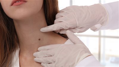 الزوائد الجلدية تعرف علي سببها و طرق علاجها