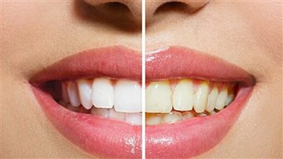 وصفات سحرية لتبيض الاسنان بأقل التكاليف اسنانك هتنور