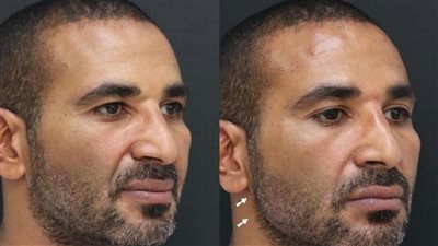 تسببت في تغيير ملامح أحمد سعد تحذير من حقن البوتكس تسبب أضرار خطيرة