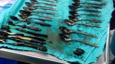شاهد بالصور استخرج ملاعق وشوك وخواتم من أمعاء مريض