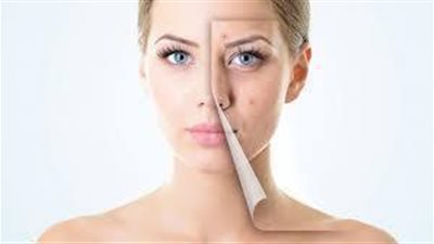 تعرف على أطعمة تصيب بحب الشباب