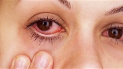 علاجات منزلية لحساسية الغبار