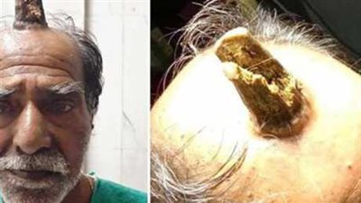 تعرض لأشعة الشمس.. ذو القرن يثير ضجة في الهند
