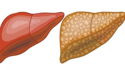 تعرف على طرق طبيعية للتخلص من مرض الكبد الدهني